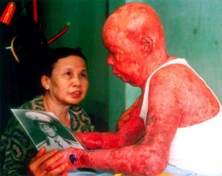Vietnamese Officer Suffering From Agent Orange Exposure, 1985